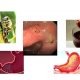 apiterapia ulcerului gastro duodenal